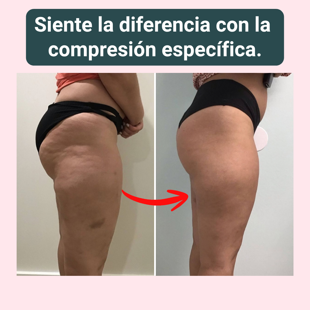 NOVA | 3D Compression Leggings for Lymphedema Comfort