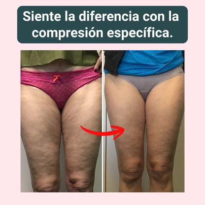 NOVA | 3D Compression Leggings for Lymphedema Comfort